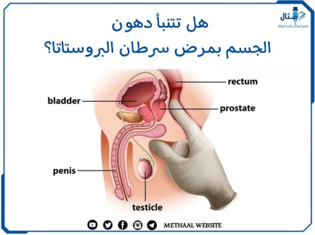 هل تتنبأ دهون الجسم بمرض سرطان البروستاتا؟