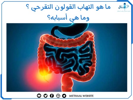 ما هو التهاب القولون التقرحي ؟ وما هي أسبابه؟