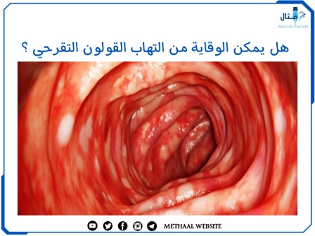 هل يمكن الوقاية من التهاب القولون التقرحي؟