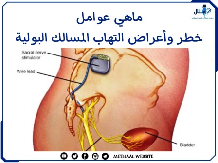 ما هي عوامل خطر وأعراض التهاب المسالك البولية