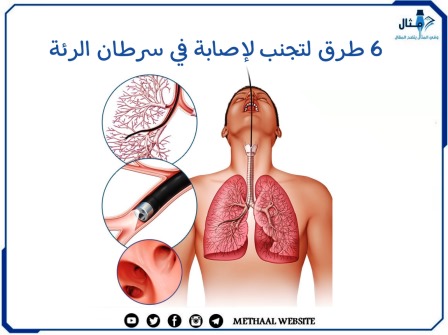 6 طرق لتجنب لإصابة في سرطان الرئة