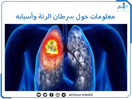 معلومات حول سرطان الرئة وأسبابه