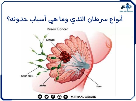 أنواع سرطان الثدي وما هي أسباب حدوثه؟