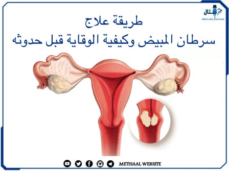 طرق علاج سرطان المبيض وكيفية الوقاية قبل حدوثه