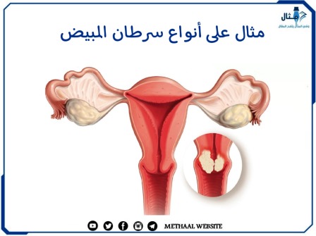 ما هي أعراض سرطان المبيض وأسباب الإصابة به؟