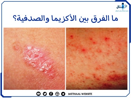 ما الفرق بين الأكزيما والصدفية