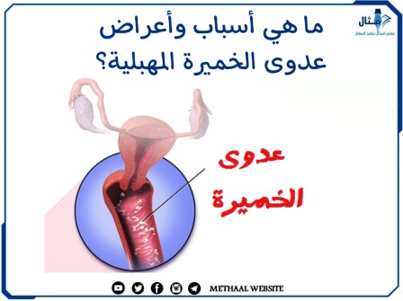 ما هي أسباب وأعراض عدوى الخميرة المهبلية؟