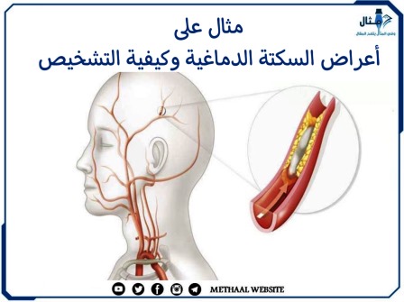 مثال على أعراض السكتة الدماغية وكيفية التشخيص