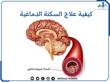 كيفية علاج السكتة الدماغية