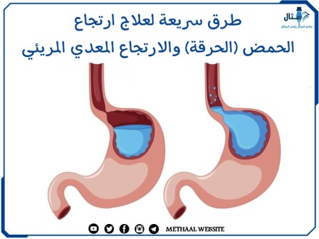 طرق سريعة لعلاج ارتجاع الحمض (الحرقة) والارتجاع المعدي المريئي