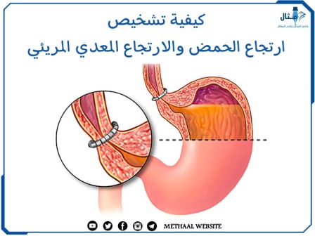 كيفية تشخيص ارتجاع الحمض والارتجاع المعدي المريئي