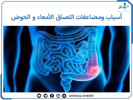 أسباب ومضاعفات التصاق الأمعاء والحوض