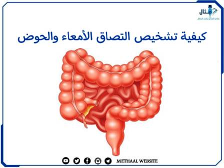 كيفية تشخيص التصاق الأمعاء والحوض