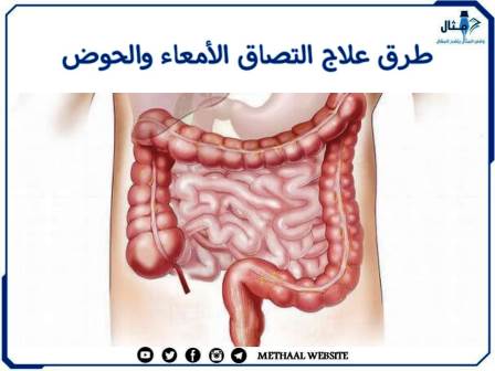 طرق علاج التصاق الأمعاء والحوض