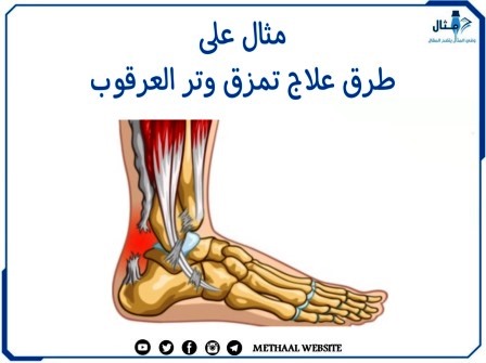 مثال على طرق علاج تمزق وتر العرقوب