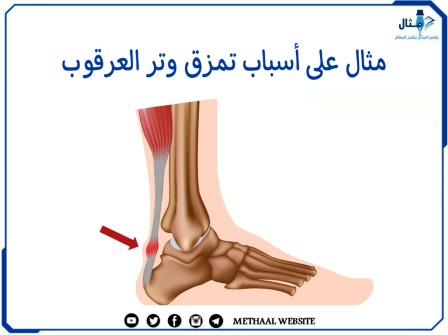 مثال على أسباب تمزق وتر العرقوب