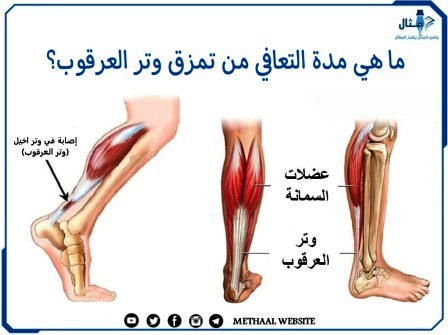 ما هي مدة التعافي من تمزق وتر العرقوب؟