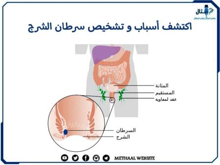 اكتشف أسباب وتشخيص سرطان الشرج