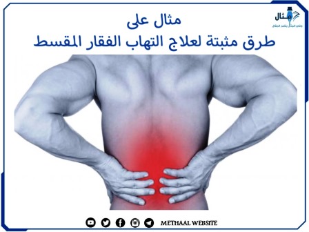 مثال على طرق مثبتة لعلاج التهاب الفقار المقسط