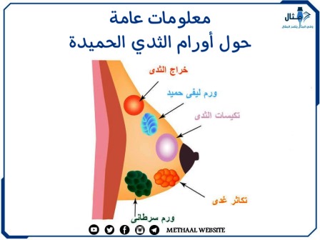 معلومات عامة حول أورام الثدي الحميدة