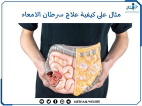 مثال على كيفية علاج سرطان الامعاء مثال على كيفية علاج سرطان الامعاء