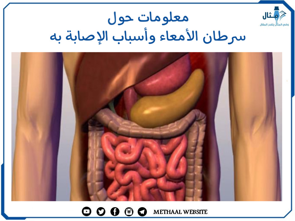 معلومات حول سرطان الأمعاء وأسباب الإصابة به