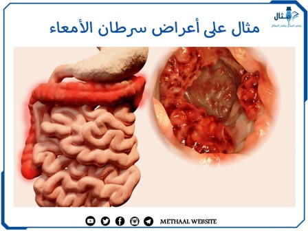 مثال على أعراض سرطان الأمعاء