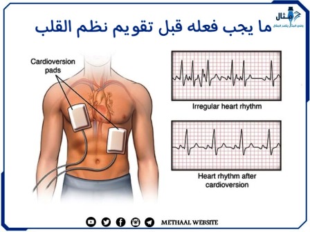 ما يجب فعله قبل تقويم نظم القلب