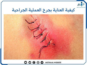 كيفية العناية بجرح العملية الجراحية كيفية العناية بجرح العملية الجراحية