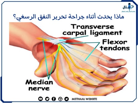 ماذا يحدث أثناء جراحة تحرير النفق الرسغي؟