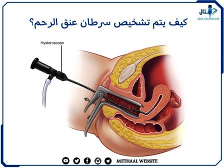 كيف يتم تشخيص سرطان عنق الرحم؟