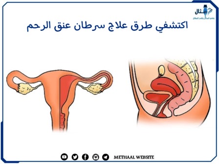 اكتشفي طرق علاج سرطان عنق الرحم