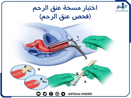 اختبار مسحة عنق الرحم (فحص عنق الرحم)