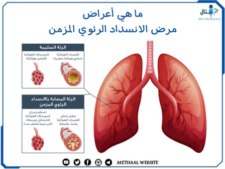 ما هي أعراض مرض الانسداد الرئوي المزمن