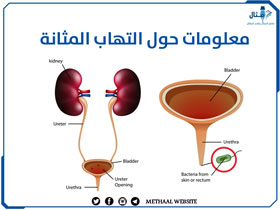 معلومات حول التهاب المثانة معلومات حول التهاب المثانة
