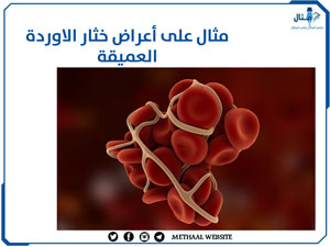 مثال على أعراض خثار الاوردة العميقة