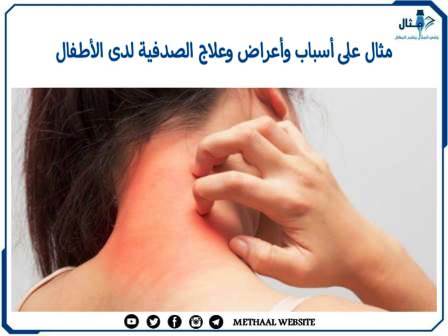 مثال على أسباب وأعراض وعلاج الصدفية لدى الأطفال